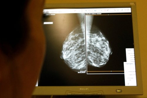 FILE PHOTO: A doctor exams mammograms, a special type of X-ray of the breasts, which is used to detect tumours as part of a regular cancer prevention medical check-up at a clinic in Nice, south eastern France January 4, 2008.