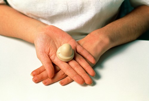 Contraception: a cervical cap