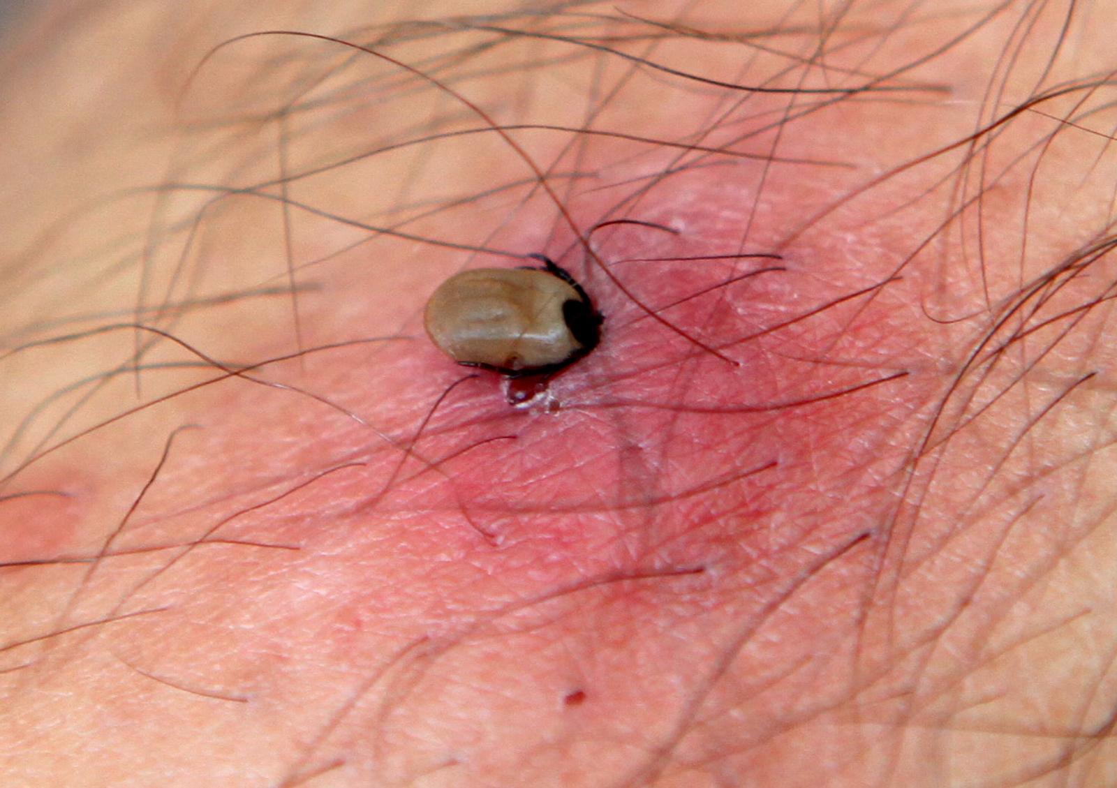 Zagreb: Dolaskom toplijih dana pove?ana je opasnost od ugriza krpelja