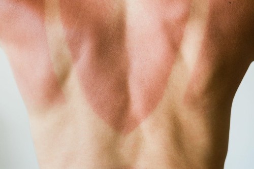 Close-up of a sunburn marks on a woman's back