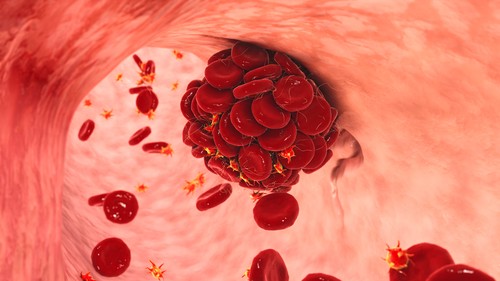 Blood clot, illustration