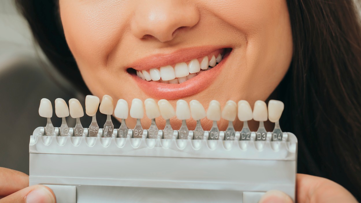 Teeth whitening sample colours