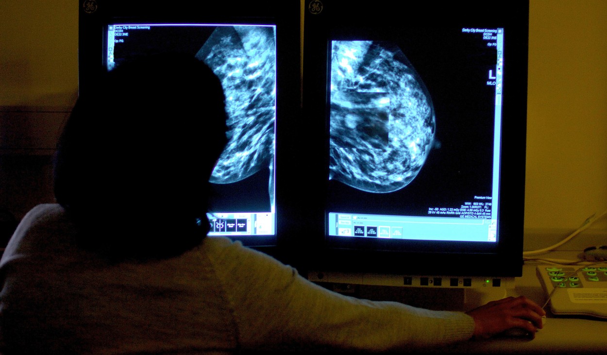 profi Breast cancer screening