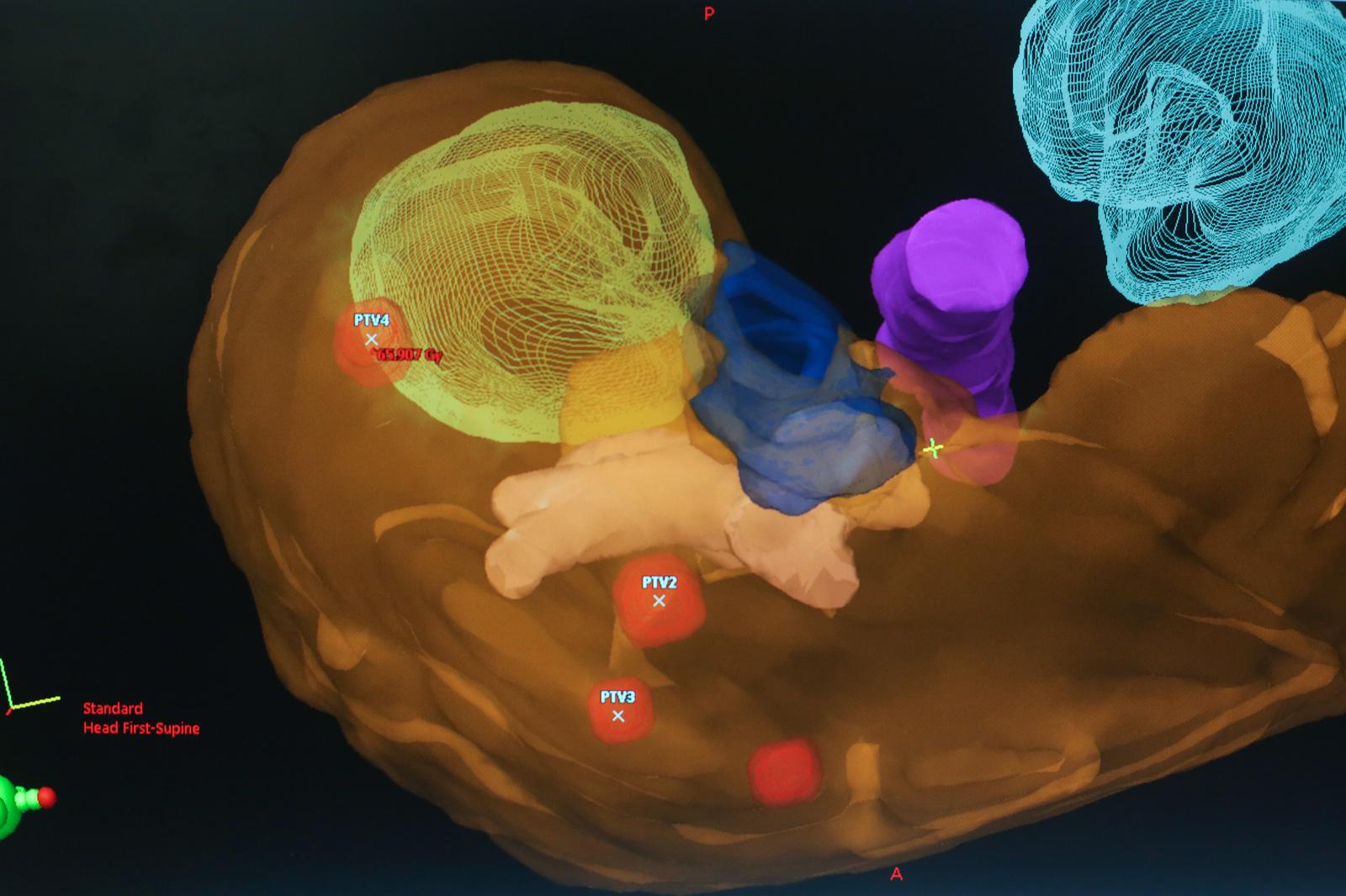 Sveta Nedjelja: Ravnatelj Radiochirurgije Zagreb Dragan Schwarz