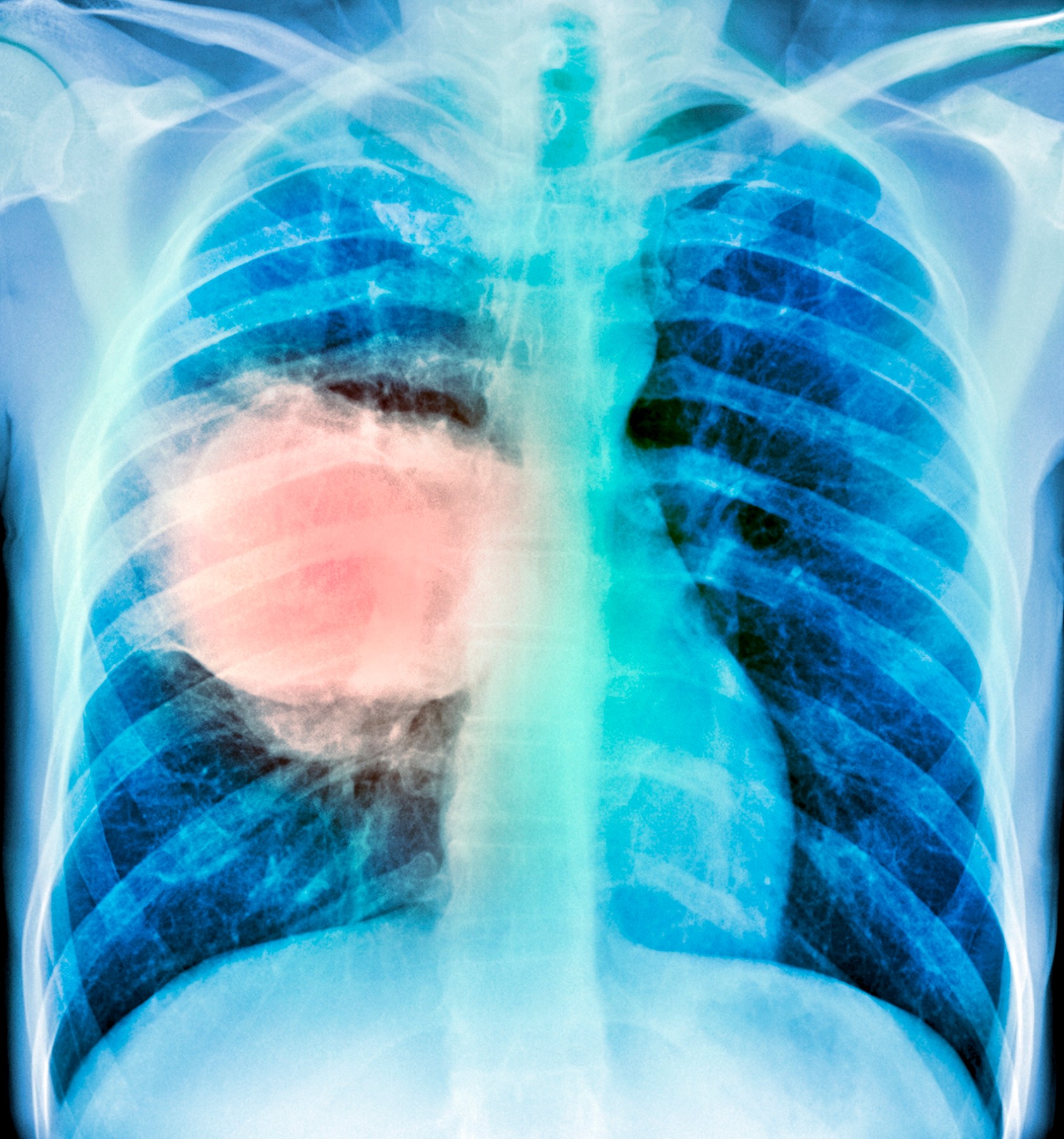 rak pluća, karcinom