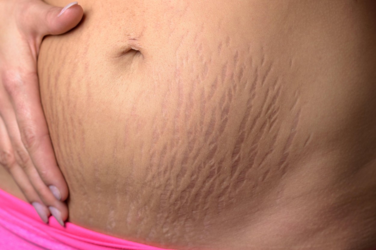 Woman displaying stretch marks on her abdomen after pregnancy caused by tearing of the dermis layer of the skin and showing as r