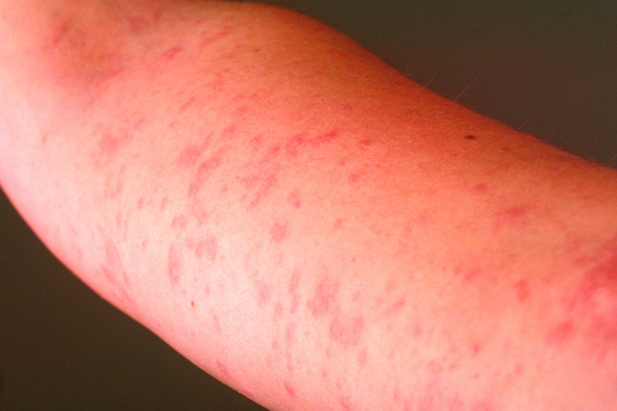 URTICARIA