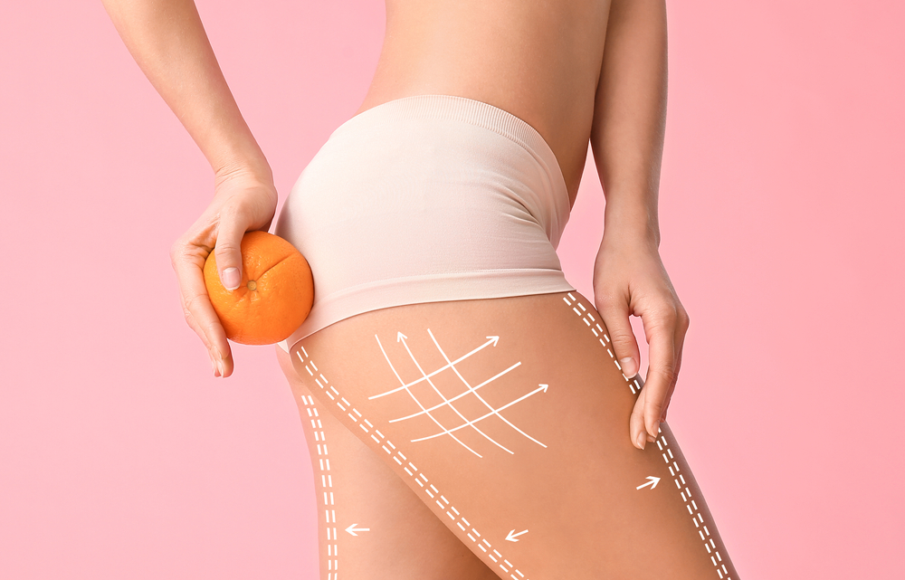 žena, naranča, celulit, tijelo, bedra