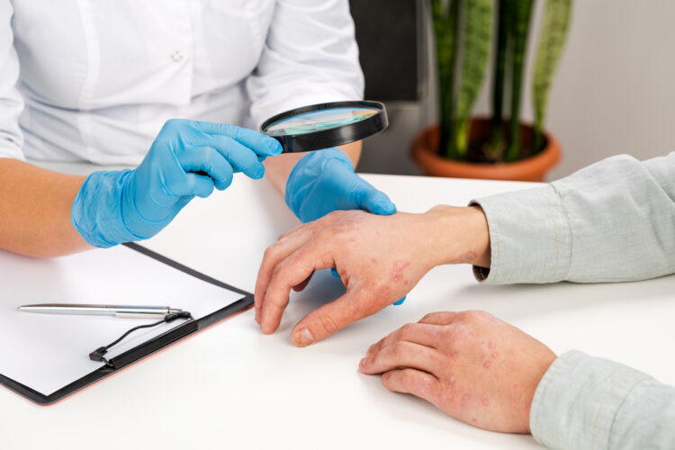 ekcem, koža, dermatolog, pregled, psorijaza SHUTTERSTOCK