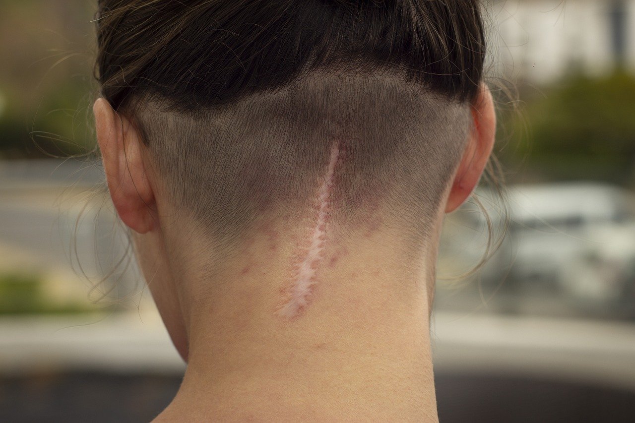 scar, ožiljak, ožiljci,