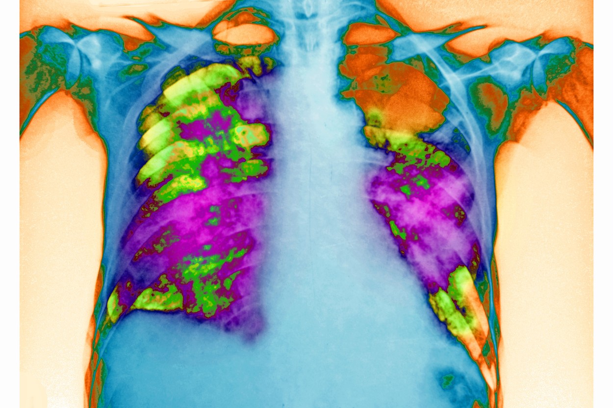 PNEUMOCYSTIS PNEUMONIA