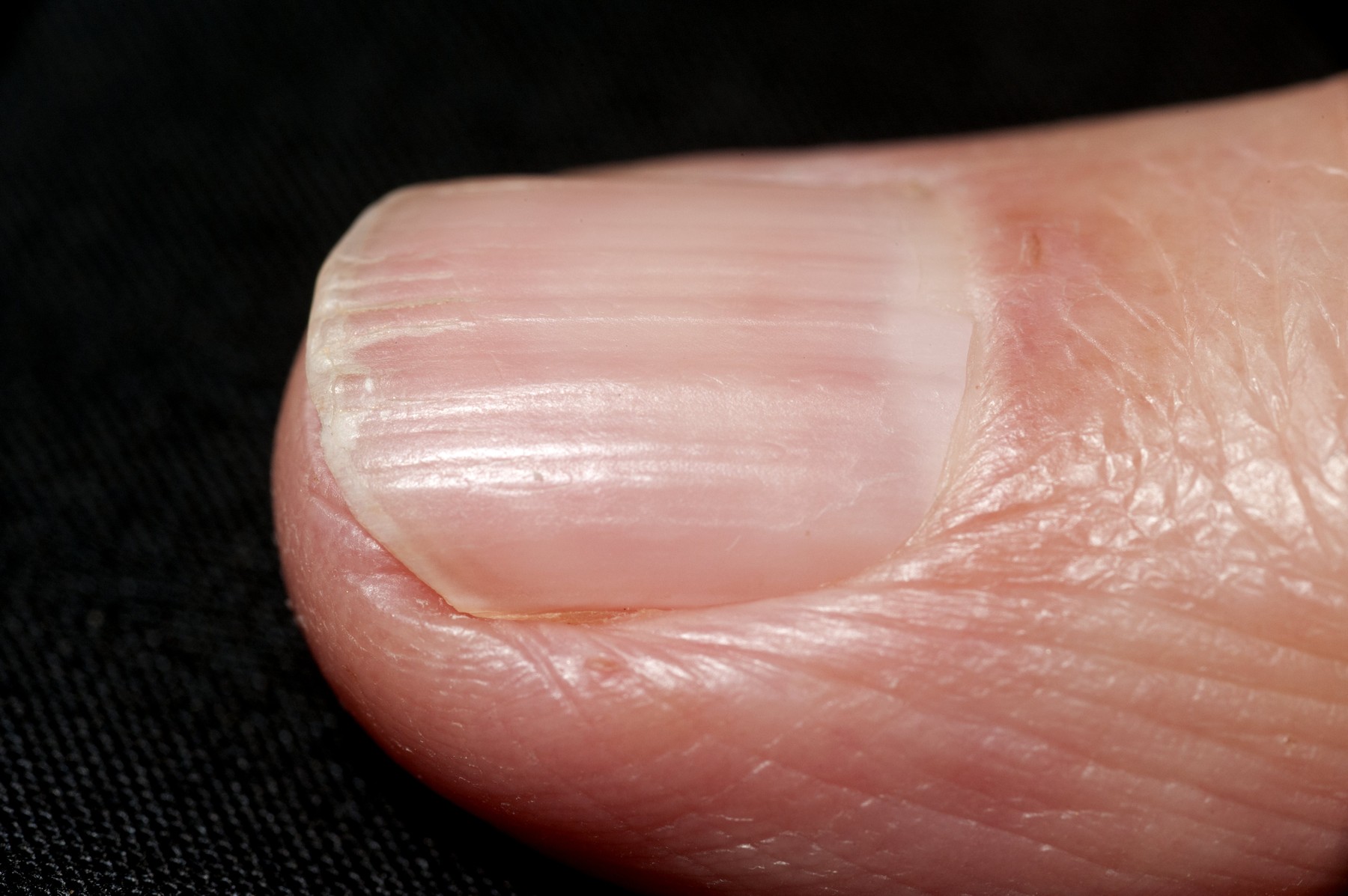 Ridged fingernail in psoriasis