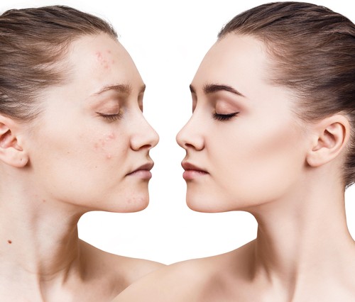 Girl with acne before and after treatment