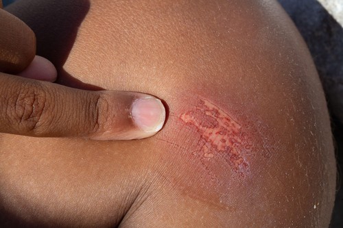 Close up of a healing wound on brown skin with a finger pointing at it