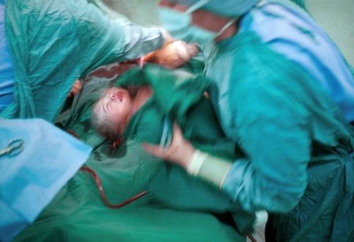 Caesarean section