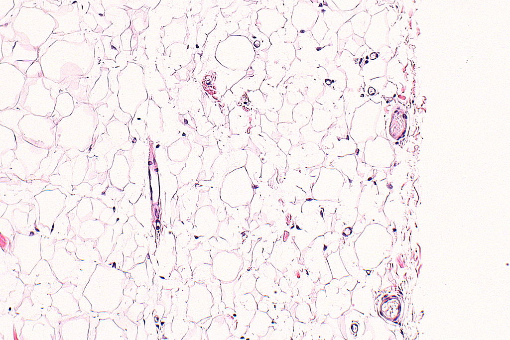 Wikimedia Commons_Lipom