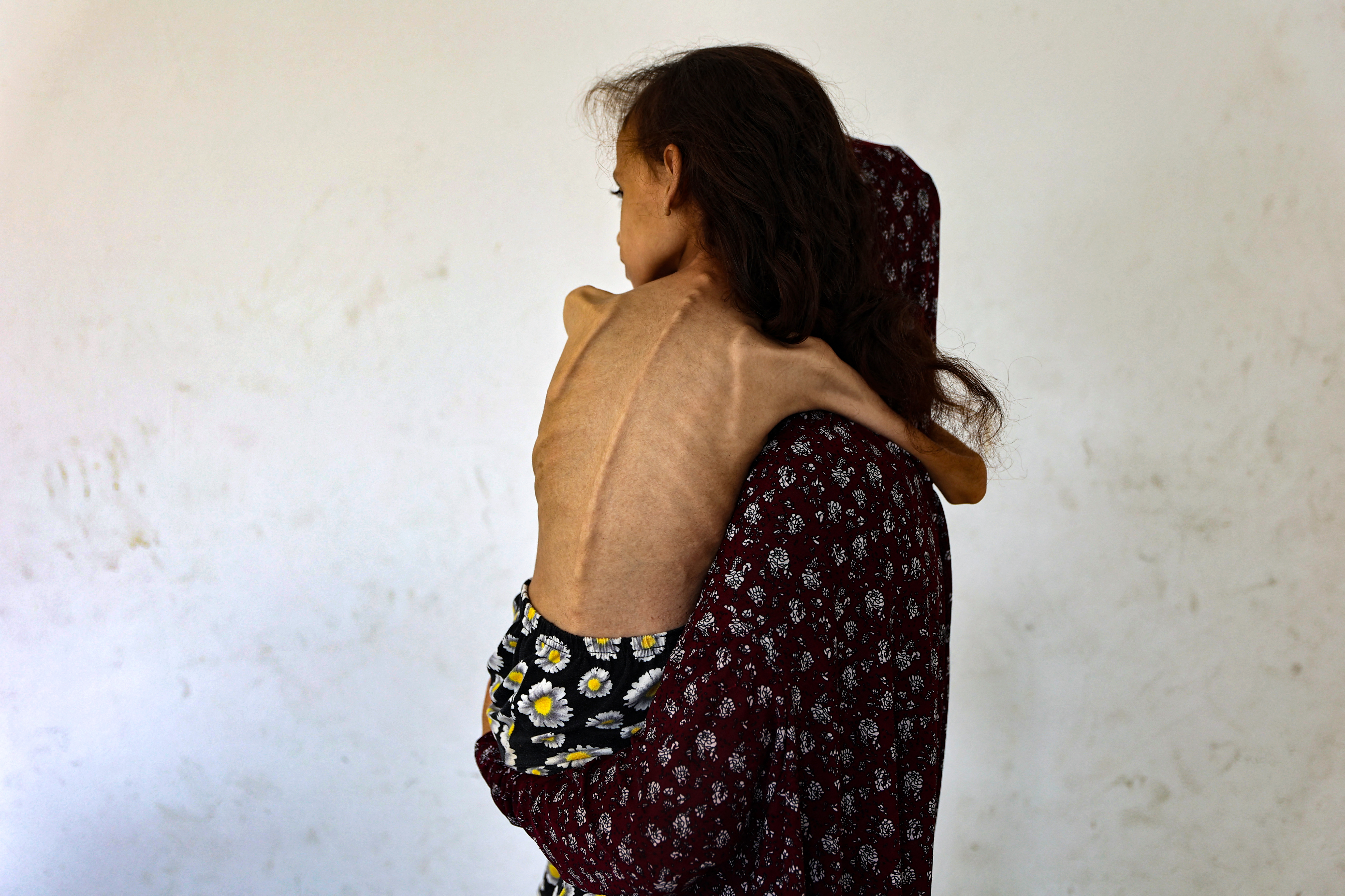 Nine-year-old malnourished Palestinian girl Mariam Dawwas is carried by her mother in the Rimal neighbourhood in Gaza City on August 2, 2025.