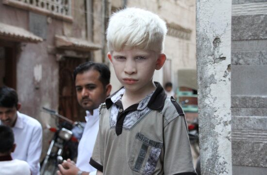 albino, dječak
