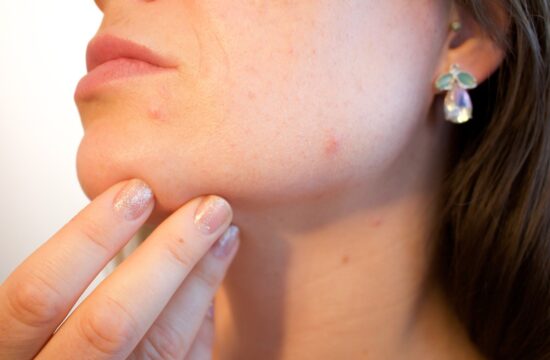 Dermatolog objasnio kada je prištić zapravo znak puno ozbiljnijeg problema